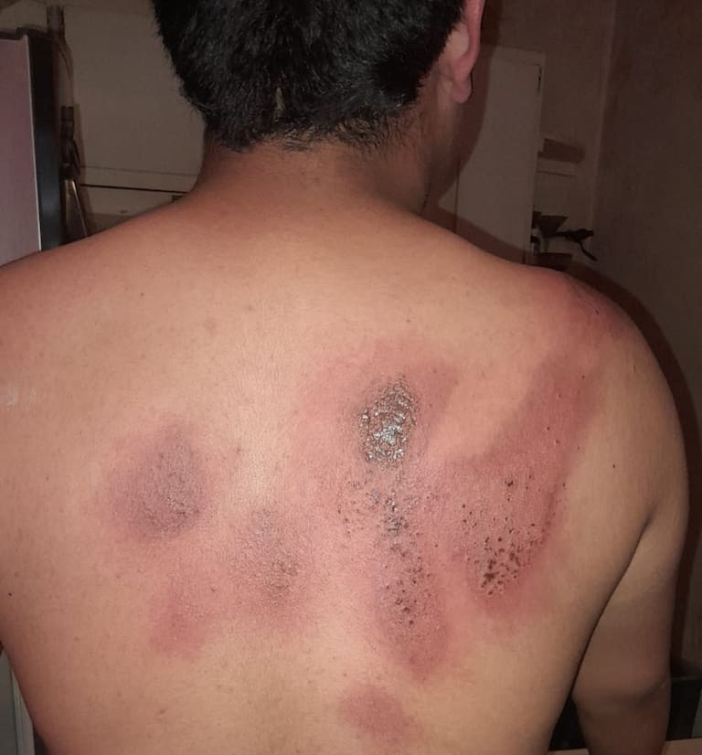 Estudiante de secundaria lesionado por compañeros con sosa cáustica